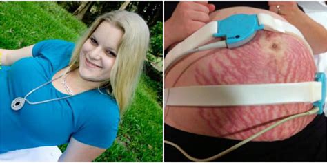 Mom Speaks Out After Itchy Pregnant Belly Turns Into Huge Rash
