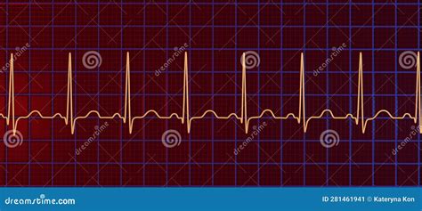Electrocardiogram Ecg Displaying Sinus Tachycardia D Illustration