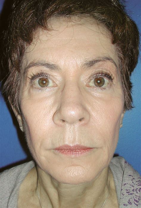 Patient22 Before Vargas Face And Skin Center