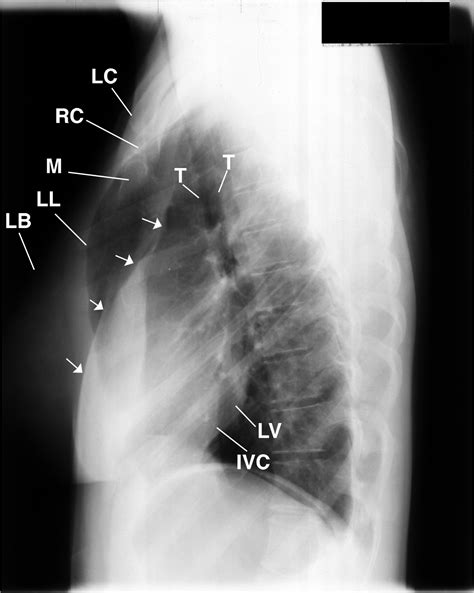 Stomach ribs lungs picture : Why Does This Patient Have a Hyperlucent Right Lung and Rib Deformities?