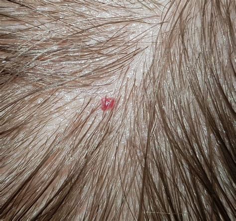 Roter Pickel Auf Der Kopfhaut Angst Vor Hautkrebs