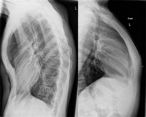 833 likes · 9 talking about this. Comparison of two chest wall deformities: pectus excavatum ...