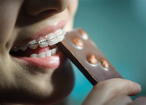 What To Not Eat With Braces A Preventative Guide Orthodontics