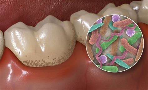 How Do You Kill Bacteria In Your Mouth Naturally Oral Hygiene
