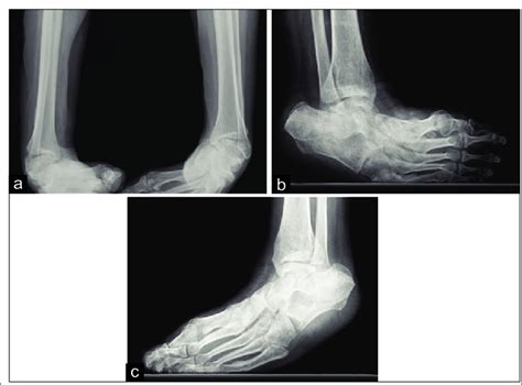 Plain Radiograph Showing Pre Operative Bilateral Ankle Bilateral Ankle