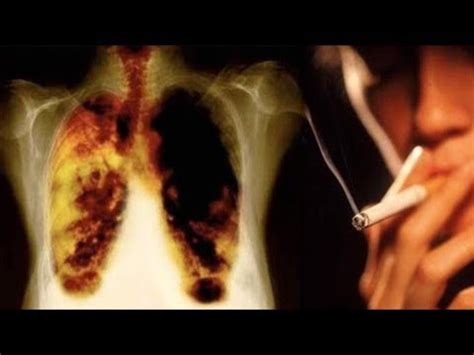 Todav A Quieren Fumar M Dico Muestra C Mo Funcionan Pulmones Sanos