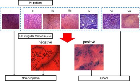 Combined Endocytoscopy With Pit Pattern Diagnosis In Ulcerative Colitis