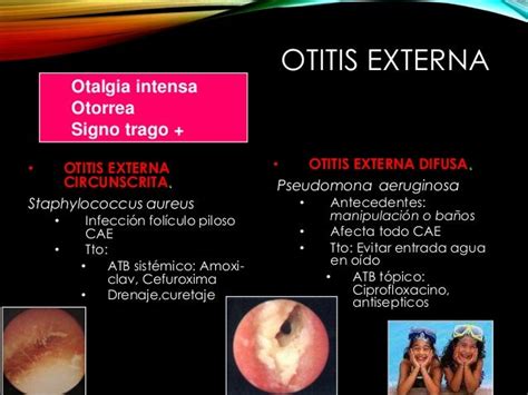 Sinusitis Otitis Y Mastoiditis