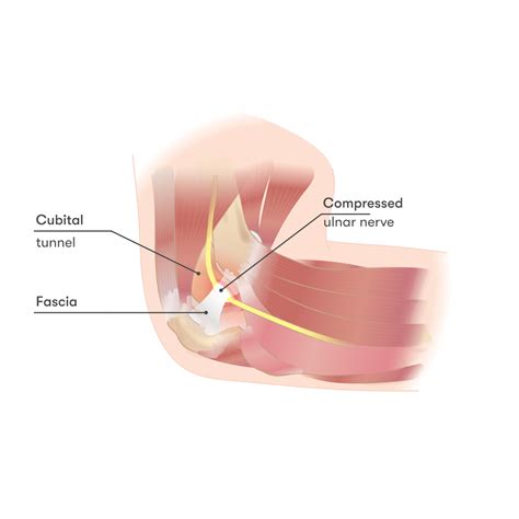 Elbow Injuries Symptoms Treatment Guide And Recovery Time