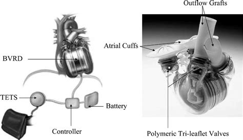 The Abiocor Total Artiicial Heart Is The Rst Fully Implantable Bvrd