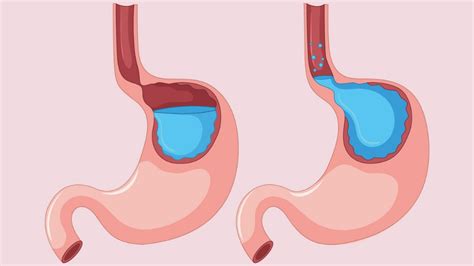7 Easy Ways To Tame Excessive Gas And Improve Digestive Health 1md