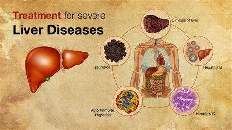 Liver Treatment For Severe Liver Diseases Facts About Liver Diseases