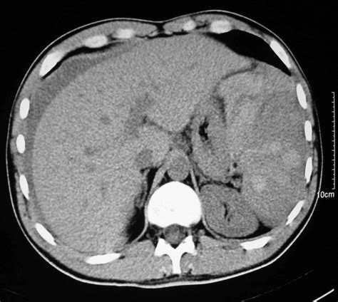 Ct Diagnosis Of Spontaneous Rupture Of Spleen As The Initial