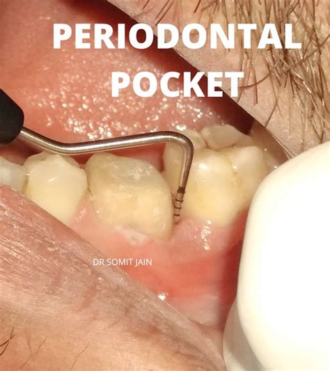 The Periodontal Pocket Prestige Dental Care