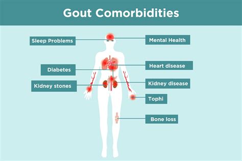 Gout Complications And Comorbidities What Gout Patients Need To Know