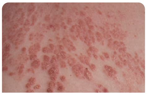 What Is Psoriasis Symptoms Causes And Diagnosis I4u