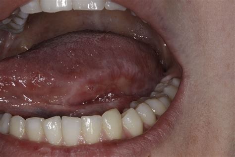 Oral Cancer Lesions On Tongue Images And Photos Finder