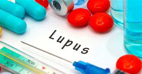 Para Poder Tratar El Lupus Es Clave Que Lo Detectes A Tiempo