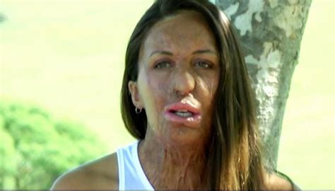 Turia Pitt Badly Burned In Marathon Fire Talks Mental Resilience Newshub
