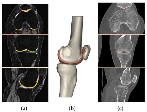 Diagnostics Free Full Text Ct And Mri Based 3d Reconstruction Of