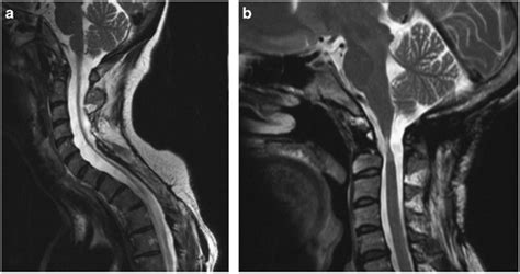 T2 Weighted Magnetic Resonance Imaging Showing Spinal Cord Atrophy