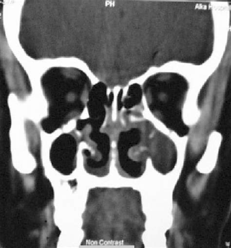 Ct Scan Of Pns Showing Left Maxillary Antral Mass With Possible