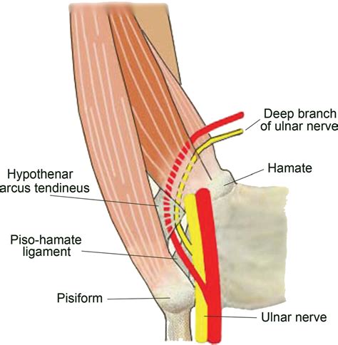Ulnar Nerve Deep Branch Compression By A Ganglion A Review Of Nine