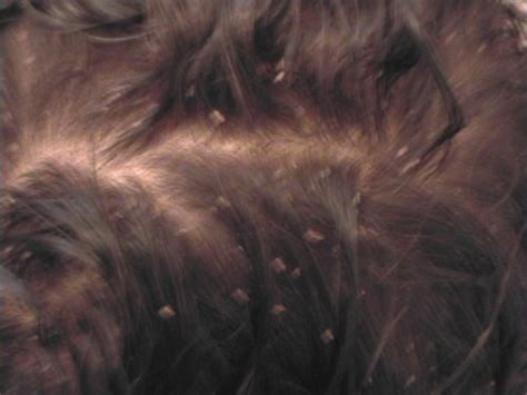 Because fine hair is so, well, fine it is especially vulnerable to breakage, which is why heat styling is generally not advised. How To Get Rid Of Head Lice | Olodo Nation