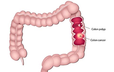 an overview of colon cancer ponirevo