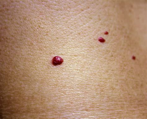 Top 5 Conditions Often Mistaken For Skin Cancer