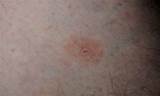 Images of Lyme Disease Rash Itch Treatment