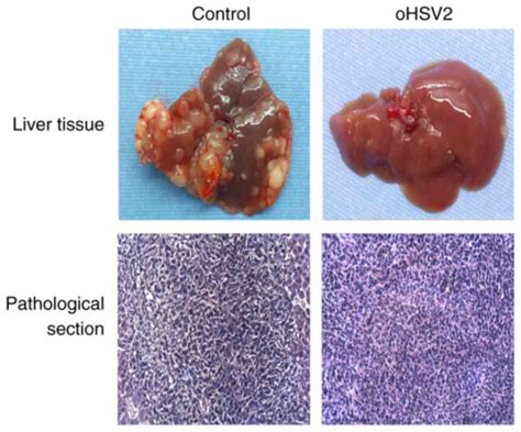 Inhibition Of Colorectal Cancer Liver Metastasis In Balbc Mice