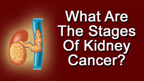 Can You Cure Stage 4 Kidney Cancer
