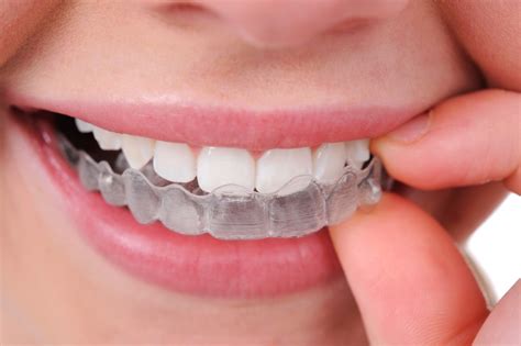 Professional Dental Care What Are Invisible Braces