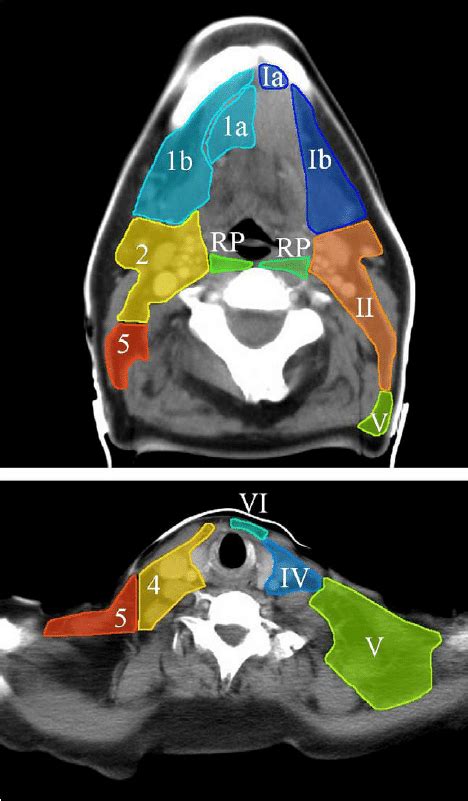 Lymph Node Stations Neck Radiology News Current Station In The Word