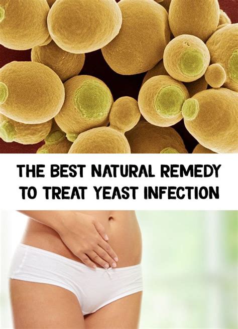 The Best Natural Remedy To Treat Yeast Infection Yeast Infection