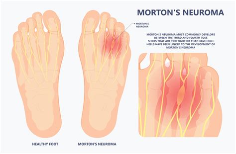 Mortons Neuroma Perth Orthopaedic Specialist Centre