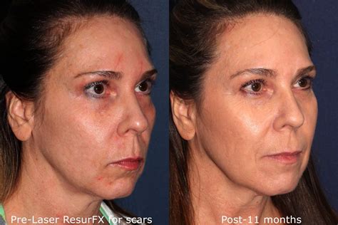 Resurfx San Diego Ca Cosmetic Laser Dermatology