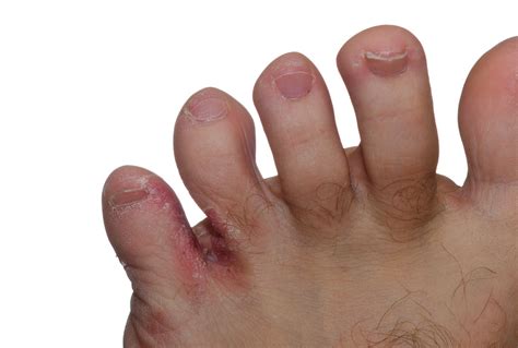 Fungal Skin Infections Ipswich Podiatry Centre