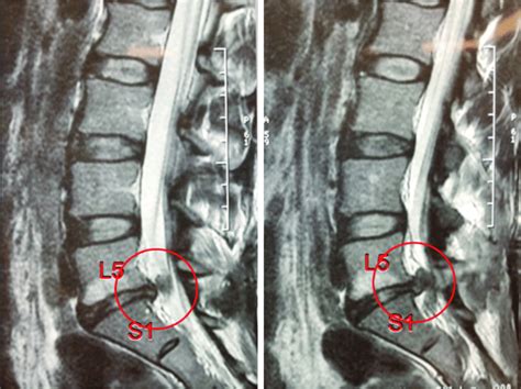 My pain pills had worn off completely and i wasn't given valium or anything. Recurrent disc herniation L5/S1 with Modic endplate changes and loss of... | Download Scientific ...