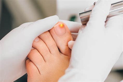 Fungal Nail Infection Laser Treatment My Footdr