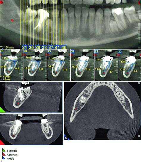Transverse Cuts On Cone Beam Computed Tomography Cbct A And