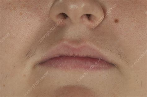 Excessive Female Facial Hair Growth Stock Image C0296422 Science