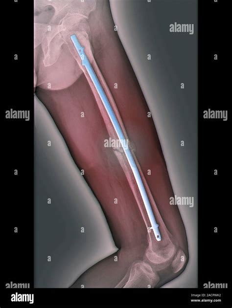 Pinned Thigh Fracture Coloured X Ray Of The Fractured Femur Thigh