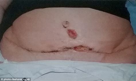 Mother Who Won £150k After Bad Tummy Tuck Says Cosmetic Surgery Has
