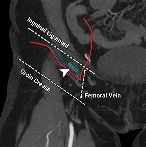 Vascularized Lymph Node Transfer A Primer For The Radiologist