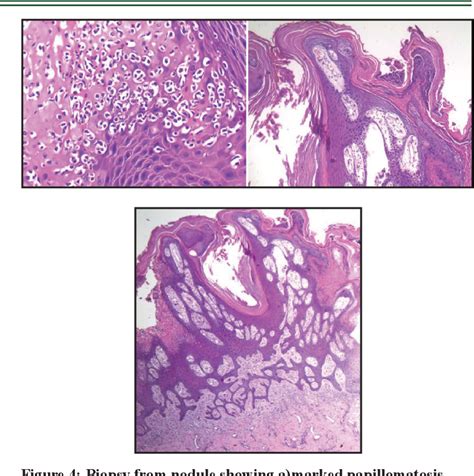 Figure 2 From Unilateral Verrucous Psoriasis On The Leg A Rare