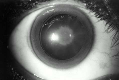 Previous eye injury or inflammation 8. cataracts, cataracts question and answers | Firmoo Answers