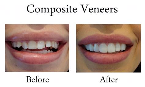 Two Front Teeth Veneers Before And After Teethwalls