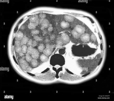 Ct Scan Slices Showing Extensive Metastatic Liver Cancer Stock Photo